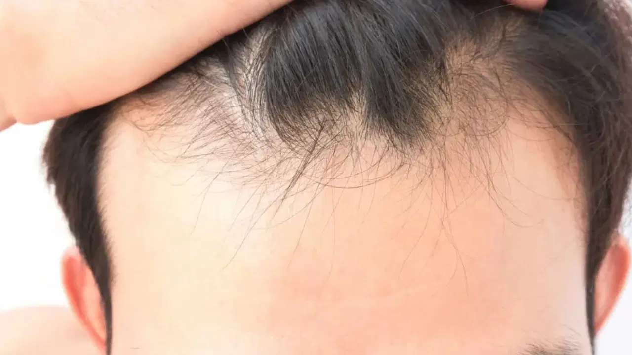 sac dokulmesinde gizli neden vitamin ve mineral eksikligi ne kadar etkili swVGB92z.jpg